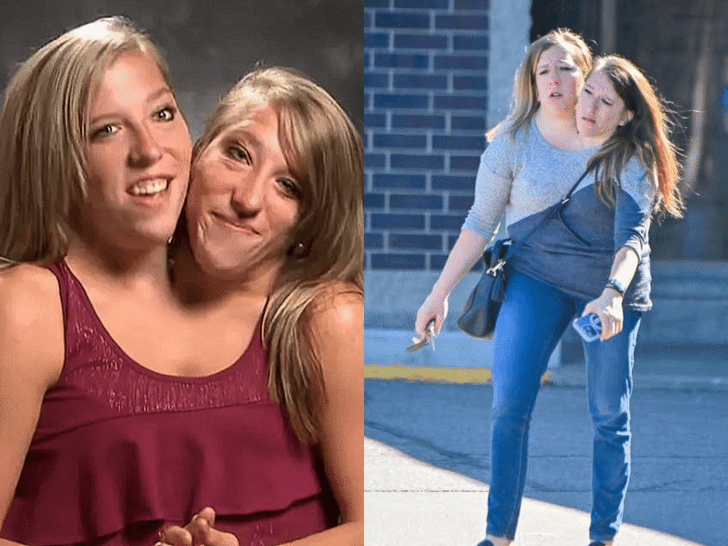 siamesische zwillinge abby und brittany