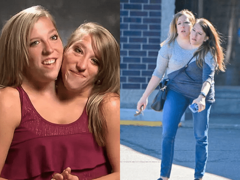 siamesische zwillinge abby und brittany